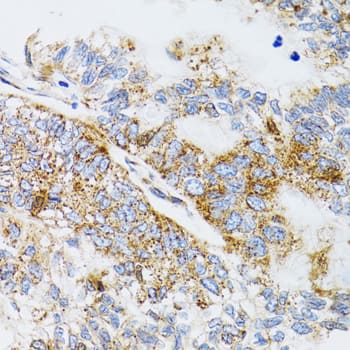 Immunohistochemistry: Prodynorphin/PDYN Antibody [NBP3-38195] - Immunohistochemistry analysis of paraffin-embedded Human gastric cancer using Prodynorphin/PDYN Rabbit pAb at dilution of 1:100 (40x lens). Microwave antigen retrieval performed with 0.01M PBS Buffer (pH 7.2) prior to IHC staining.