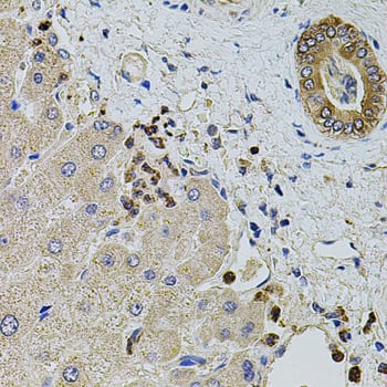 Immunohistochemistry: kinectin Antibody [NBP3-38206] - Immunohistochemistry analysis of paraffin-embedded Human liver damage using kinectin Rabbit pAb at dilution of 1:100 (40x lens). Microwave antigen retrieval performed with 0.01M PBS Buffer (pH 7.2) prior to IHC staining.
