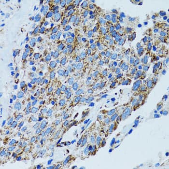 Immunohistochemistry: MRPL28 Antibody [NBP3-38209] - Immunohistochemistry analysis of paraffin-embedded Human lung cancer using MRPL28 Rabbit pAb at dilution of 1:100 (40x lens). Microwave antigen retrieval performed with 0.01M PBS Buffer (pH 7.2) prior to IHC staining.