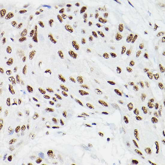 Immunohistochemistry: CPSF6 Antibody [NBP3-38219] - Immunohistochemistry analysis of paraffin-embedded Human esophageal cancer using CPSF6 Rabbit pAb at dilution of 1:100 (40x lens). High pressure antigen retrieval performed with 0.01M Citrate Bufferr (pH 6.0) prior to IHC staining.