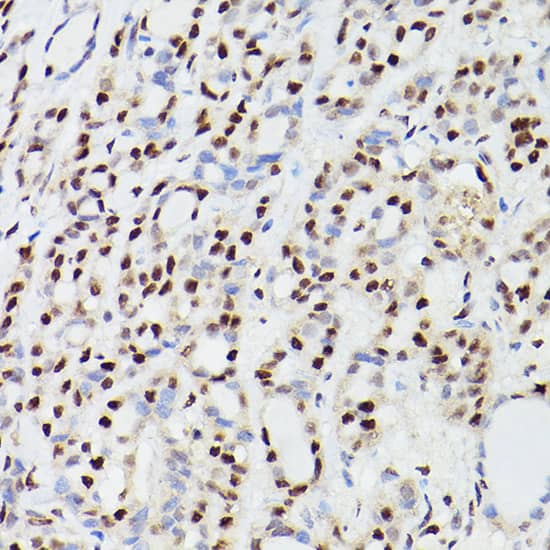 Immunohistochemistry: CPSF6 Antibody [NBP3-38219] - Immunohistochemistry analysis of paraffin-embedded Human thyroid cancer using CPSF6 Rabbit pAb at dilution of 1:100 (40x lens). High pressure antigen retrieval performed with 0.01M Citrate Bufferr (pH 6.0) prior to IHC staining.