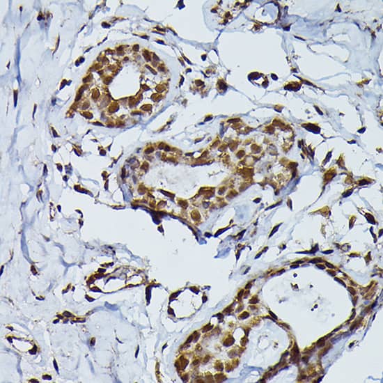 Immunohistochemistry: PRPF4 Antibody [NBP3-38223] - Immunohistochemistry analysis of paraffin-embedded Human breast cancer using PRPF4 Rabbit pAb at dilution of 1:200 (40x lens). High pressure antigen retrieval performed with 0.01M Citrate Bufferr (pH 6.0) prior to IHC staining.