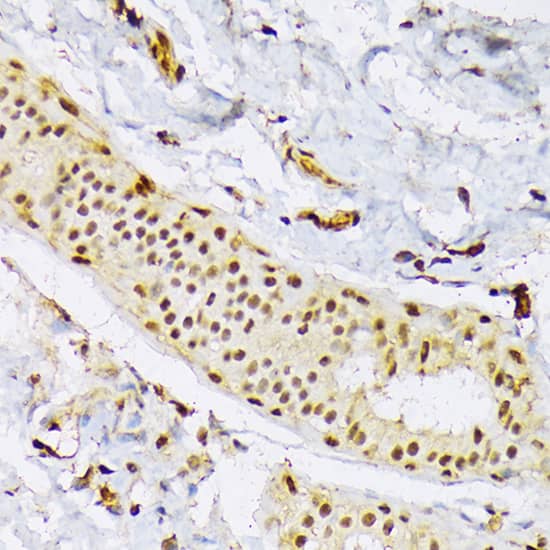 Immunohistochemistry: SFRS3 Antibody [NBP3-38224] - Immunohistochemistry analysis of paraffin-embedded Human mammary cancer using SFRS3 Rabbit pAb at dilution of 1:100 (40x lens). Microwave antigen retrieval performed with 0.01M PBS Buffer (pH 7.2) prior to IHC staining.