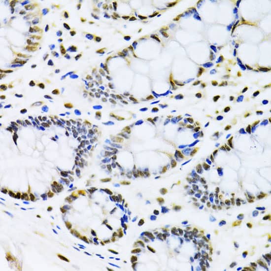 Immunohistochemistry: Cbx8 Antibody [NBP3-38232] - Immunohistochemistry analysis of paraffin-embedded Human colon using Cbx8 Rabbit pAb at dilution of 1:100 (40x lens). Microwave antigen retrieval performed with 0.01M PBS Buffer (pH 7.2) prior to IHC staining.