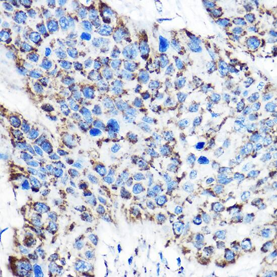 Immunohistochemistry: OAT Antibody [NBP3-38234] - Immunohistochemistry analysis of paraffin-embedded Human esophageal cancer using OAT Rabbit pAb at dilution of 1:100 (40x lens). High pressure antigen retrieval performed with 0.01M Citrate Bufferr (pH 6.0) prior to IHC staining.