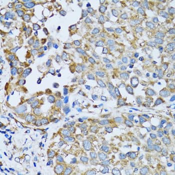 Immunohistochemistry: Arginyl tRNA synthetase Antibody [NBP3-38241] - Immunohistochemistry analysis of paraffin-embedded Human lung cancer using Arginyl tRNA synthetase Rabbit pAb at dilution of 1:100 (40x lens). Microwave antigen retrieval performed with 0.01M PBS Buffer (pH 7.2) prior to IHC staining.