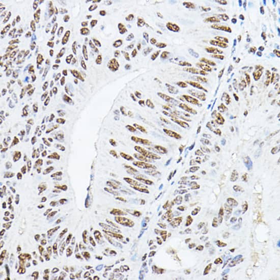 Immunohistochemistry: GAS41 Antibody [NBP3-38243] - Immunohistochemistry analysis of paraffin-embedded Human colon carcinoma using GAS41 Rabbit pAb at dilution of 1:100 (40x lens). High pressure antigen retrieval performed with 0.01M Citrate Bufferr (pH 6.0) prior to IHC staining.