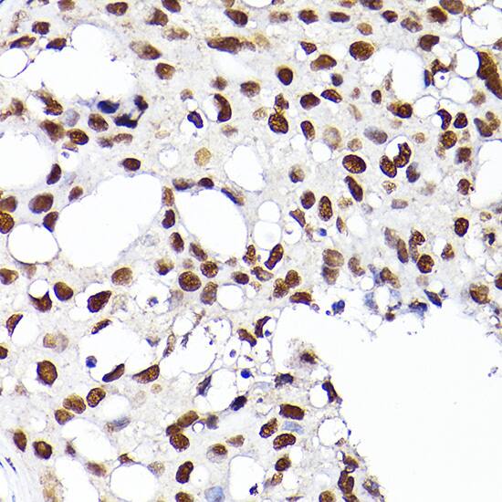 Immunohistochemistry: RCC1 Antibody [NBP3-38248] - Immunohistochemistry analysis of paraffin-embedded Human breast cancer using RCC1 Rabbit pAb at dilution of 1:200 (40x lens). High pressure antigen retrieval performed with 0.01M Citrate Bufferr (pH 6.0) prior to IHC staining.