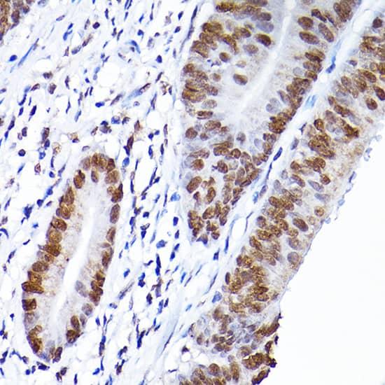 Immunohistochemistry: RCC1 Antibody [NBP3-38248] - Immunohistochemistry analysis of paraffin-embedded Human colon carcinoma using RCC1 Rabbit pAb at dilution of 1:200 (40x lens). High pressure antigen retrieval performed with 0.01M Citrate Bufferr (pH 6.0) prior to IHC staining.