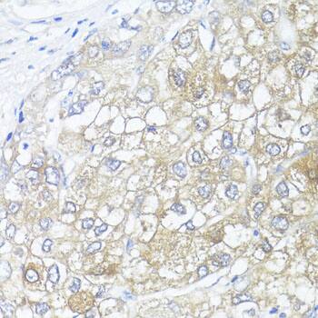 Immunohistochemistry: Argininosuccinate Lyase Antibody [NBP3-38249] - Immunohistochemistry analysis of paraffin-embedded Human liver cancer using Argininosuccinate Lyase Rabbit pAb at dilution of 1:100 (40x lens). Microwave antigen retrieval performed with 0.01M PBS Buffer (pH 7.2) prior to IHC staining.