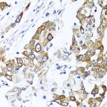 Immunohistochemistry: PPOX Antibody [NBP3-38257] - Immunohistochemistry analysis of paraffin-embedded Human colon carcinoma using PPOX Rabbit pAb at dilution of 1:100 (40x lens). Microwave antigen retrieval performed with 0.01M PBS Buffer (pH 7.2) prior to IHC staining.