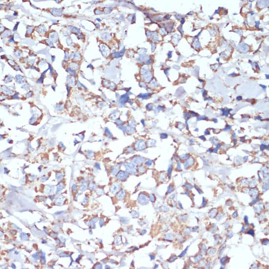 Immunohistochemistry: COX5A Antibody [NBP3-38264] - Immunohistochemistry analysis of paraffin-embedded Human breast cancer using COX5A Rabbit pAb at dilution of 1:100 (40x lens). Microwave antigen retrieval performed with 0.01M PBS Buffer (pH 7.2) prior to IHC staining.