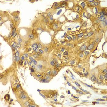 Immunohistochemistry: Calpain S1 Antibody [NBP3-38281] - Immunohistochemistry analysis of paraffin-embedded Human liver cancer using Calpain S1 Rabbit pAb at dilution of 1:100 (40x lens). Microwave antigen retrieval performed with 0.01M PBS Buffer (pH 7.2) prior to IHC staining.