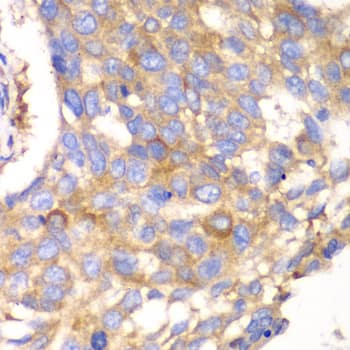 Immunohistochemistry: Calpain S1 Antibody [NBP3-38281] - Immunohistochemistry analysis of paraffin-embedded Human esophageal cancer using Calpain S1 Rabbit pAb at dilution of 1:100 (40x lens). Microwave antigen retrieval performed with 0.01M PBS Buffer (pH 7.2) prior to IHC staining.