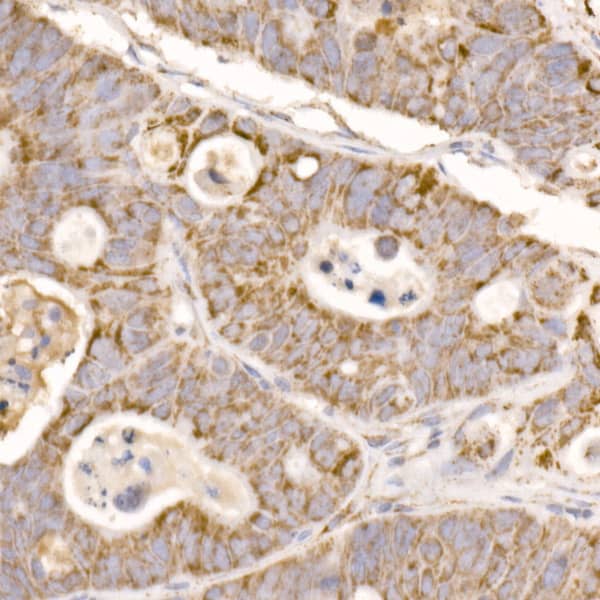 Immunohistochemistry: Glutamate Dehydrogenase 2/GLUD2 Antibody [NBP3-38295] - Immunohistochemistry analysis of paraffin-embedded Human colon carcinoma using Glutamate Dehydrogenase 2/GLUD2 Rabbit pAb at dilution of 1:50 (40x lens). High pressure antigen retrieval performed with 0.01M Citrate Bufferr (pH 6.0) prior to IHC staining.