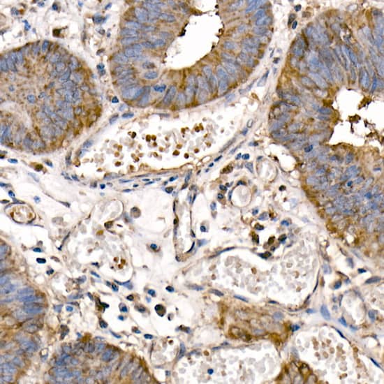 Immunohistochemistry: NFkB p105/p50 Antibody [NBP3-38305] - Immunohistochemistry analysis of paraffin-embedded Human colon carcinoma using NFkB p105/p50 Rabbit pAb at dilution of 1:50 (40x lens). High pressure antigen retrieval performed with 0.01M Citrate Bufferr (pH 6.0) prior to IHC staining.