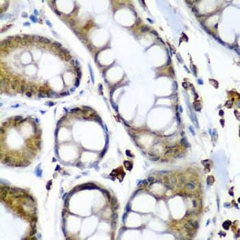 Immunohistochemistry: SECISBP2 Antibody [NBP3-38323] - Immunohistochemistry analysis of paraffin-embedded Human colon carcinoma using SECISBP2 Rabbit pAb at dilution of 1:200 (40x lens). Microwave antigen retrieval performed with 0.01M PBS Buffer (pH 7.2) prior to IHC staining.