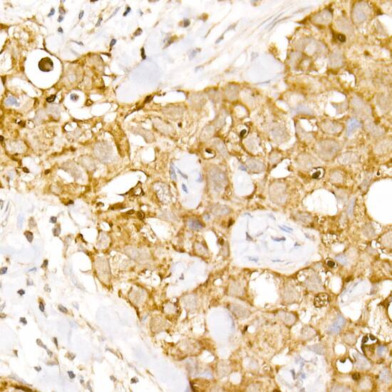 Immunohistochemistry: AP3B1 Antibody [NBP3-38363] - Immunohistochemistry analysis of paraffin-embedded Human breast cancer using AP3B1 Rabbit pAb at dilution of 1:100 (40x lens). High pressure antigen retrieval performed with 0.01M Citrate Bufferr (pH 6.0) prior to IHC staining.