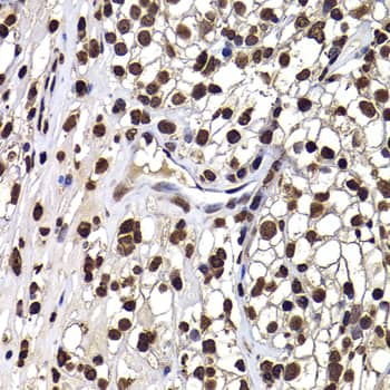 Immunohistochemistry: DNAJB6 Antibody [NBP3-38371] - Immunohistochemistry analysis of paraffin-embedded Human kidney cancer using DNAJB6 Rabbit pAb at dilution of 1:100 (40x lens). Microwave antigen retrieval performed with 0.01M PBS Buffer (pH 7.2) prior to IHC staining.