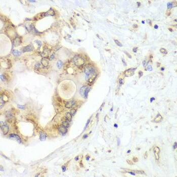 Immunohistochemistry: VTI1B Antibody [NBP3-38375] - Immunohistochemistry analysis of paraffin-embedded Human liver cancer using VTI1B Rabbit pAb at dilution of 1:100 (40x lens). Microwave antigen retrieval performed with 0.01M PBS Buffer (pH 7.2) prior to IHC staining.