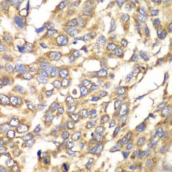 Immunohistochemistry: VTI1B Antibody [NBP3-38375] - Immunohistochemistry analysis of paraffin-embedded Human esophageal cancer using VTI1B Rabbit pAb at dilution of 1:100 (40x lens). Microwave antigen retrieval performed with 0.01M PBS Buffer (pH 7.2) prior to IHC staining.