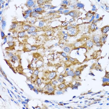 Immunohistochemistry: NDE1 Antibody [NBP3-38386] - Immunohistochemistry analysis of paraffin-embedded Human breast cancer using NDE1 Rabbit pAb at dilution of 1:100 (40x lens). Microwave antigen retrieval performed with 0.01M PBS Buffer (pH 7.2) prior to IHC staining.