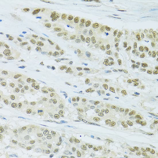 Immunohistochemistry: FIP1L1 Antibody [NBP3-38392] - Immunohistochemistry analysis of paraffin-embedded Human colon carcinoma using FIP1L1 Rabbit pAb at dilution of 1:100 (40x lens). Microwave antigen retrieval performed with 0.01M PBS Buffer (pH 7.2) prior to IHC staining.