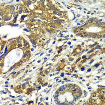 Immunohistochemistry: CDC16 Antibody [NBP3-38396] - Immunohistochemistry analysis of paraffin-embedded Human gastric cancer using CDC16 Rabbit pAb at dilution of 1:100 (40x lens). Microwave antigen retrieval performed with 0.01M PBS Buffer (pH 7.2) prior to IHC staining.