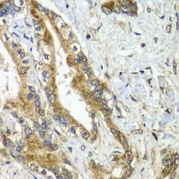 Immunohistochemistry: CDC16 Antibody [NBP3-38396] - Immunohistochemistry analysis of paraffin-embedded Human liver cancer using CDC16 Rabbit pAb at dilution of 1:100 (40x lens). Microwave antigen retrieval performed with 0.01M PBS Buffer (pH 7.2) prior to IHC staining.