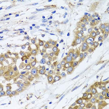 Immunohistochemistry: PEX14 Antibody [NBP3-38414] - Immunohistochemistry analysis of paraffin-embedded Human colon carcinoma using PEX14 Rabbit pAb at dilution of 1:100 (40x lens). Microwave antigen retrieval performed with 0.01M PBS Buffer (pH 7.2) prior to IHC staining.