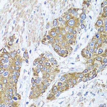 Immunohistochemistry: PEX14 Antibody [NBP3-38414] - Immunohistochemistry analysis of paraffin-embedded Human prostate cancer using PEX14 Rabbit pAb at dilution of 1:100 (40x lens). Microwave antigen retrieval performed with 0.01M PBS Buffer (pH 7.2) prior to IHC staining.