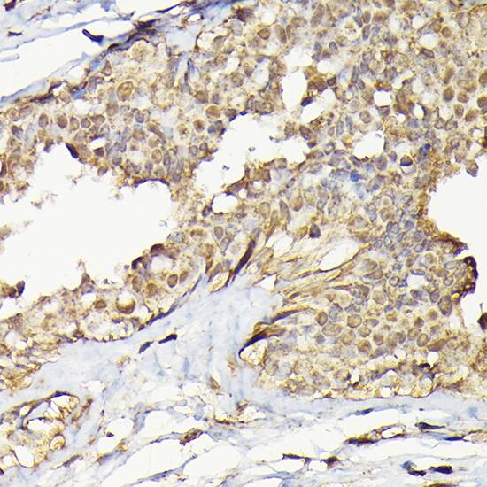 Immunohistochemistry: TRBP Antibody [NBP3-38439] - Immunohistochemistry analysis of paraffin-embedded Human breast cancer using TRBP Rabbit pAb at dilution of 1:200 (40x lens). High pressure antigen retrieval performed with 0.01M Citrate Bufferr (pH 6.0) prior to IHC staining.