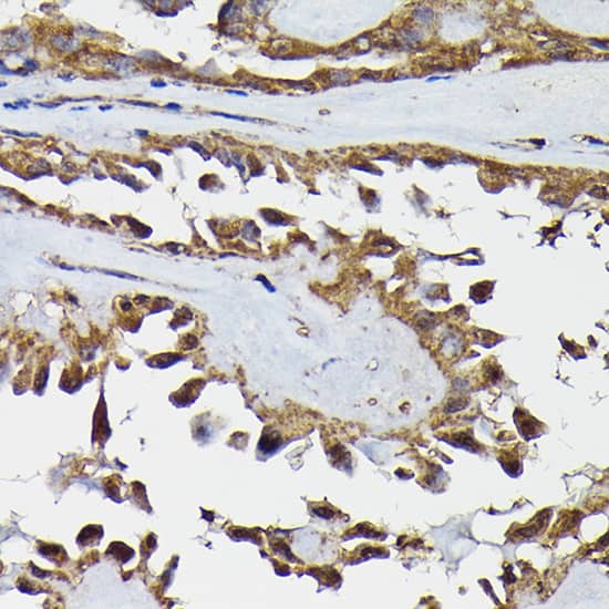 Immunohistochemistry: TRBP Antibody [NBP3-38439] - Immunohistochemistry analysis of paraffin-embedded Human thyroid cancer using TRBP Rabbit pAb at dilution of 1:200 (40x lens). High pressure antigen retrieval performed with 0.01M Citrate Bufferr (pH 6.0) prior to IHC staining.