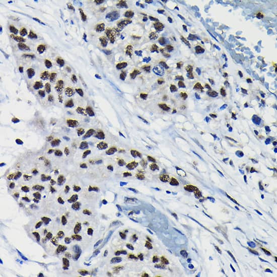 Immunohistochemistry: DRIL1 Antibody [NBP3-38452] - Immunohistochemistry analysis of paraffin-embedded Human lung cancer using DRIL1 Rabbit pAb at dilution of 1:100 (40x lens). High pressure antigen retrieval performed with 0.01M Citrate Bufferr (pH 6.0) prior to IHC staining.