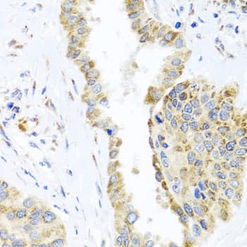 Immunohistochemistry: DARS2 Antibody [NBP3-38469] - Immunohistochemistry analysis of paraffin-embedded Human lung cancer using DARS2 Rabbit pAb at dilution of 1:100 (40x lens). Microwave antigen retrieval performed with 0.01M PBS Buffer (pH 7.2) prior to IHC staining.