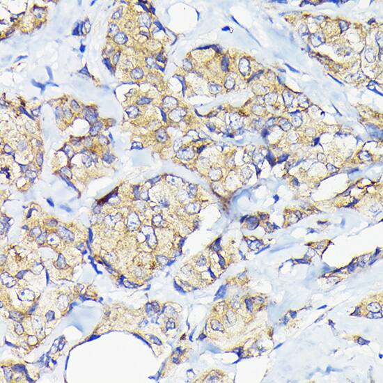Immunohistochemistry: EEF1G Antibody [NBP3-38481] - Immunohistochemistry analysis of paraffin-embedded Human breast cancer using EEF1G Rabbit pAb at dilution of 1:50 (40x lens). High pressure antigen retrieval performed with 0.01M Citrate Bufferr (pH 6.0) prior to IHC staining.