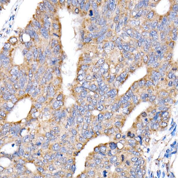 Immunohistochemistry: NDUFV1 Antibody [NBP3-38496] - Immunohistochemistry analysis of paraffin-embedded Human colon carcinoma using NDUFV1 Rabbit pAb at dilution of 1:20 (40x lens). High pressure antigen retrieval performed with 0.01M Citrate Bufferr (pH 6.0) prior to IHC staining.