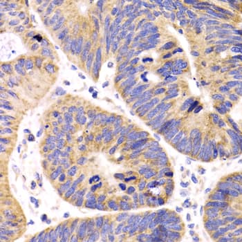 Immunohistochemistry: HMGCL Antibody [NBP3-38500] - Immunohistochemistry analysis of paraffin-embedded Human colon carcinoma using HMGCL Rabbit pAb at dilution of 1:100 (40x lens). Microwave antigen retrieval performed with 0.01M PBS Buffer (pH 7.2) prior to IHC staining.