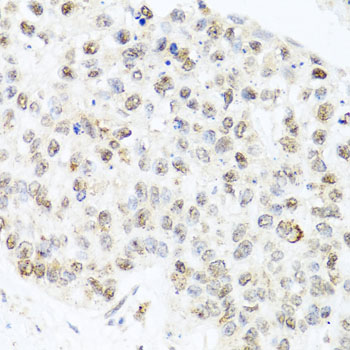 Immunohistochemistry: Centrin 3 Antibody [NBP3-38508] - Immunohistochemistry analysis of paraffin-embedded Human lung cancer using Centrin 3 Rabbit pAb at dilution of 1:100 (40x lens). Microwave antigen retrieval performed with 0.01M PBS Buffer (pH 7.2) prior to IHC staining.