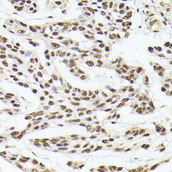 Immunohistochemistry: hHpr1-p84-Thoc1 Antibody [NBP3-38514] - Immunohistochemistry analysis of paraffin-embedded Human esophageal cancer using hHpr1-p84-Thoc1(THOC1) Rabbit pAb at dilution of 1:100 (40x lens). High pressure antigen retrieval performed with 0.01M Citrate Bufferr (pH 6.0) prior to IHC staining.