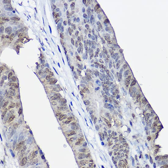 Immunohistochemistry: XPC Antibody [NBP3-38529] - Immunohistochemistry analysis of paraffin-embedded Human colon carcinoma using XPC Rabbit pAb at dilution of 1:100 (40x lens). High pressure antigen retrieval performed with 0.01M Citrate Bufferr (pH 6.0) prior to IHC staining.