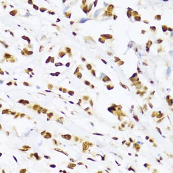 Immunohistochemistry: UAP56 Antibody [NBP3-38530] - Immunohistochemistry analysis of paraffin-embedded Human breast cancer using UAP56 Rabbit pAb at dilution of 1:100 (40x lens). Microwave antigen retrieval performed with 0.01M PBS Buffer (pH 7.2) prior to IHC staining.