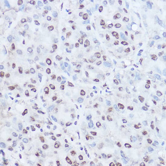 Immunohistochemistry: TAF15 Antibody [NBP3-38548] - Immunohistochemistry analysis of paraffin-embedded Human liver cancer using TAF15 Rabbit pAb at dilution of 1:100 (40x lens). High pressure antigen retrieval performed with 0.01M Citrate Bufferr (pH 6.0) prior to IHC staining.