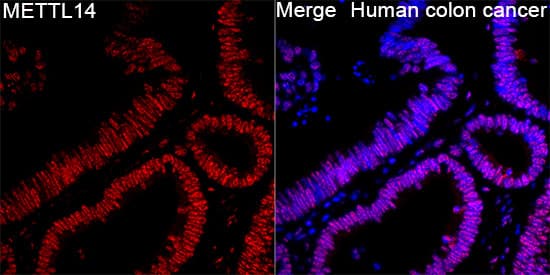 Immunocytochemistry/ Immunofluorescence: METTL14 Antibody [NBP3-38559] - Immunofluorescence analysis of Human colon cancer tissue using METTL14 Rabbit pAb at a dilution of 1:100 (40x lens). Secondary antibody: Cy3-conjugated Goat anti-Rabbit IgG (H+L)at 1:500 dilution. Blue: DAPI for nuclear staining. High pressure antigen retrieval performed with 0.01M Citrate Buffer (pH 6.0) prior to IF staining.