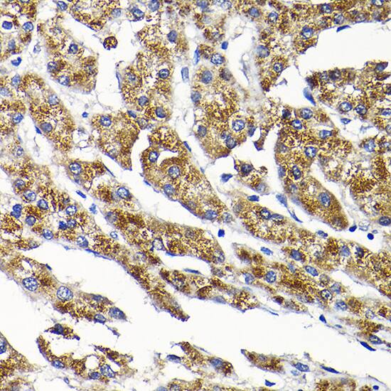 Immunohistochemistry: SCFD1 Antibody [NBP3-38582] - Immunohistochemistry analysis of paraffin-embedded Human liver cancer using SCFD1 Rabbit pAb at dilution of 1:200 (40x lens). High pressure antigen retrieval performed with 0.01M Citrate Bufferr (pH 6.0) prior to IHC staining.