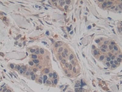 Immunohistochemistry-Paraffin: Amphiregulin Antibody (A6) [NBP3-41076] - DAB staining on IHC-P; Samples: Human Breast cancer Tissue; Primary Ab: 20ug/ml NBP3-41076; Second Ab: 2ug/mL HRP-Linked Caprine Anti-Mouse IgG Polyclonal Antibody