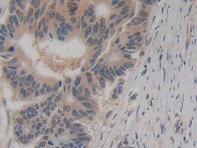 Immunohistochemistry-Paraffin: Amphiregulin Antibody (A6) [NBP3-41076] - DAB staining on IHC-P; Samples: Human Colorectal cancer Tissue; Primary Ab: 20ug/ml NBP3-41076; Second Ab: 2ug/mL HRP-Linked Caprine Anti-Mouse IgG Polyclonal Antibody