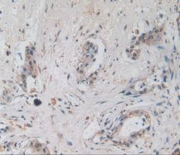 Immunohistochemistry-Paraffin: Amphiregulin Antibody (A3) [NBP3-41077] - DAB staining on IHC-P; Samples: Human Pancreas Cancer Tissue.