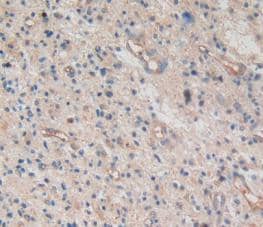 Immunohistochemistry-Paraffin: Amphiregulin Antibody (A3) [NBP3-41077] - DAB staining on IHC-P; Samples: Human Glioma Tissue.