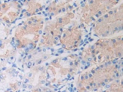 Immunohistochemistry-Paraffin: CXCL12/SDF-1 Antibody (C2) [NBP3-41080] - DAB staining on IHC-P; Sample: Human Stomach cancer Tissue; Primary Ab: 30ug/ml NBP3-41080; Second Ab: 2ug/mL HRP-Linked Caprine Anti-Mouse IgG Polyclonal Antibody